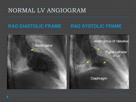 lv gram cardiology